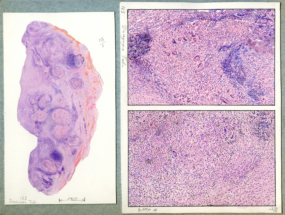 Dessins d'ophtalmologie | http://collection-jmawas.for.paris/galerie/Maladie%20appareil%20lacrymal